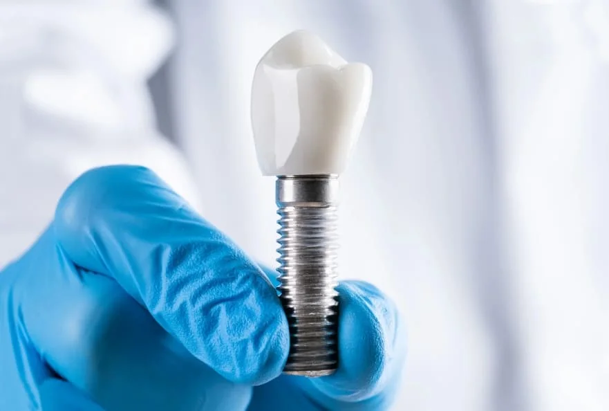 Dental-Implants